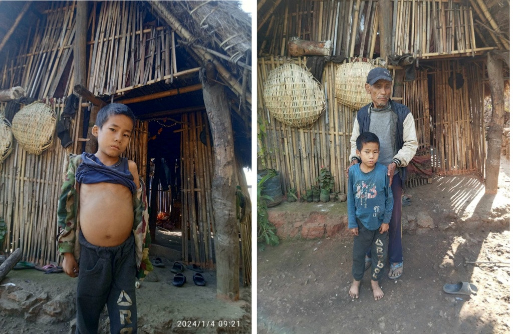 ६ महिना ओछ्यानमा थलिएका दिप्सनको उपचारका लागि एक लाख ५६ हजार जुट्यो
